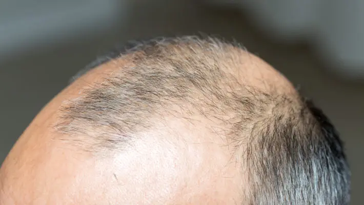 male baldness