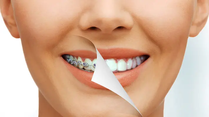 braces