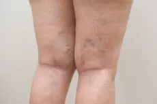 Many people experience tired legs, swelling, or cramps without realising these may be early signs of poor circulation. While some symptoms may seem harmless at first, they can signal underlying vein issues such as varicose veins, venous insufficiency, or even deep vein thrombosis (DVT).