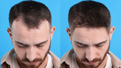 Istanbul has thousands of people who perform hair transplants and a far smaller number of doctors who do. The gap between those two groups explains nearly every bad result that reaches the news.